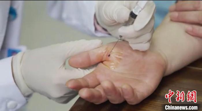 嘉善群眾體驗(yàn)小針刀?！〖紊平y(tǒng)戰(zhàn) 供圖